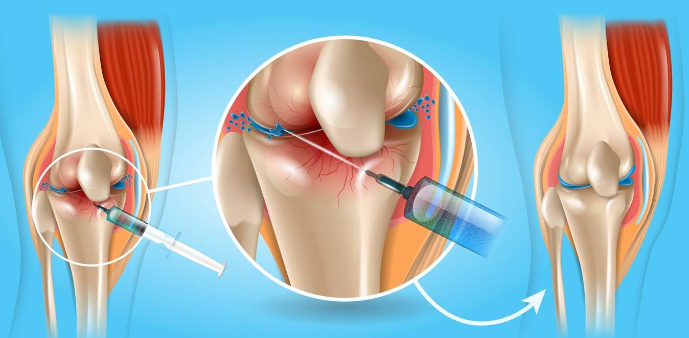 Операция по замене сустава или инъекции? Что эффективнее при лечении коленей